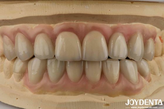 Mua Cao độ xuyên suốt Emax mỹ phẩm nha khoa veneers thẩm mỹ cao siêu mỏng sản xuất trực tuyến