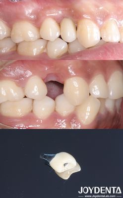 Mua Tất cả trên 4 cấy ghép răng hình trụ Titan cấy ghép răng bề mặt thô sản xuất trực tuyến