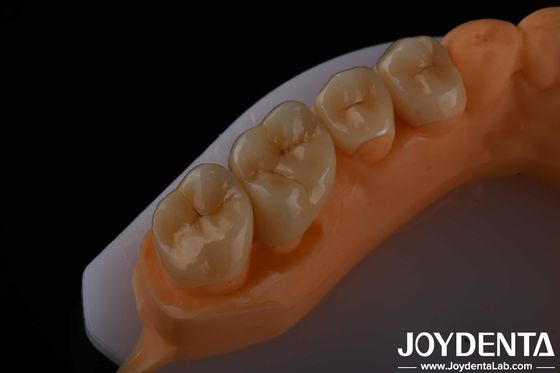 Mua Phong cách thẩm mỹ cao Full Contour Zirconia For Crowns Cây ghép răng sản xuất trực tuyến