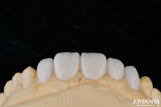 Mua Tùy chỉnh Vật liệu sứ Emax veneers răng cho Bonding thẩm mỹ cao sản xuất trực tuyến
