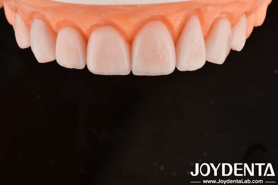 Mua IPS gốm được làm theo yêu cầu Emax veneers phục hồi răng chống vỡ sản xuất trực tuyến