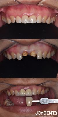 Mua Phương pháp chuẩn bị định hướng sinh học Phương pháp chuẩn bị thẳng đứng nha khoa Tiếp cận tối thiểu sản xuất trực tuyến