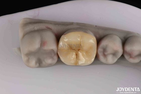Mua Thiết kế tối thiểu cho việc phục hồi răng bị hư hại sản xuất trực tuyến