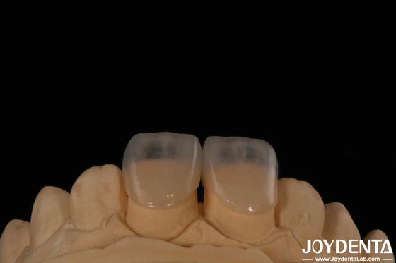 Mua Eco Friendly Micro Dental Teeth Veneer 0.2mm Độ dày Mượt mà sản xuất trực tuyến