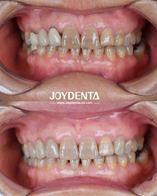Mua Circonia nha khoa nhẹ Để trải nghiệm tối ưu cho bệnh nhân Sự chuyển đổi màu sắc tự nhiên và khả năng tương thích sinh học được đảm bảo sản xuất trực tuyến
