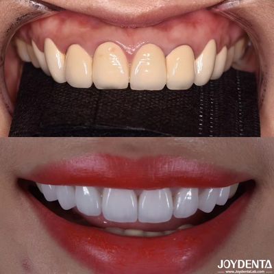 Mua CAD/CAM tương thích Zirconia vương miện nha khoa sản xuất chính xác cho phù hợp màu sắc và kích thước sản xuất trực tuyến