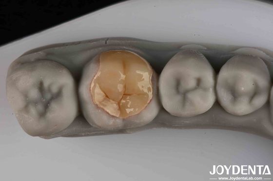 Mua Chống mài mòn và rách Rõ Transparency thấp Emax Inlay Onlay cho hiệu quả hoạt động của bạn sản xuất trực tuyến