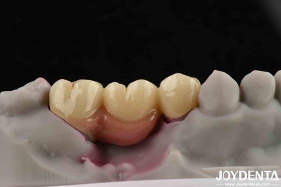 Mua Đường cầu và vương miện được hỗ trợ bằng cấy ghép nha khoa tùy chỉnh cho cấy ghép nha khoa sản xuất trực tuyến