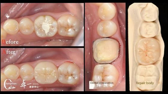 Mua Tương thích sinh học và tương thích cao với răng tự nhiên Phục hồi răng sản xuất trực tuyến