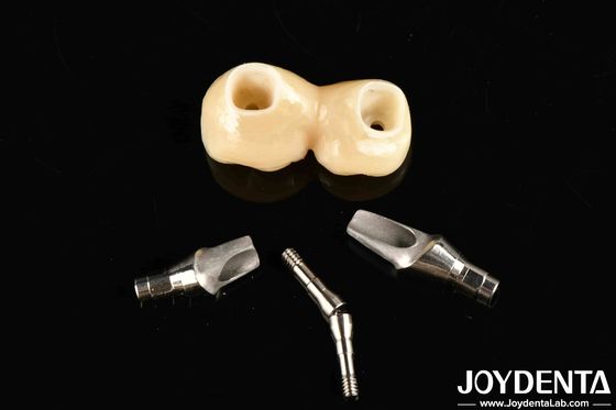 Mua Trải nghiệm kết quả thẩm mỹ với cấy ghép được tùy chỉnh Crown và cầu giữ sản xuất trực tuyến