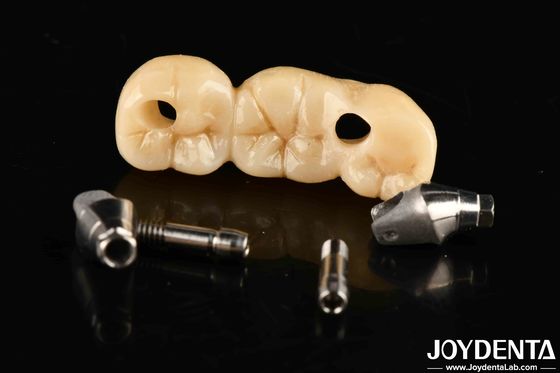 Mua Cấy ghép vương miện và cầu với thiết kế tùy chỉnh độ bền cao phù hợp chính xác sản xuất trực tuyến