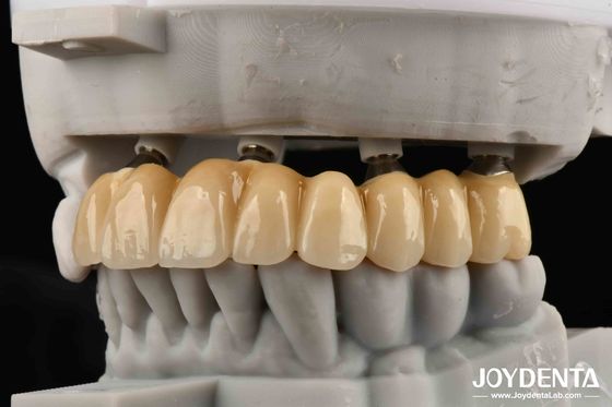Mua Bạn bè thân thiết của Tổ chức Xương Răng sứ thẩm mỹ Zirconia Lựa chọn thẩm mỹ tối thượng Không có rủi ro dị ứng kim loại sản xuất trực tuyến