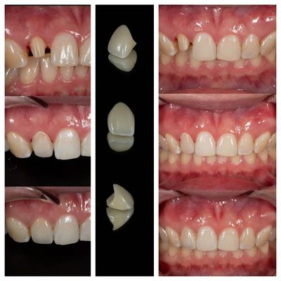 Mua Phòng thí nghiệm chế tạo mão răng Zirconia | Gia công mão răng chính xác - Joydentalab sản xuất trực tuyến