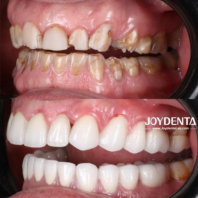 Mua Răng giả zirconia mô phỏng răng thật sản xuất trực tuyến