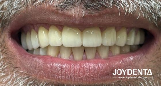 Mua Răng giả zirconia mô phỏng răng thật sản xuất trực tuyến