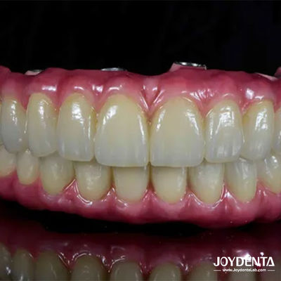 Mua Đường cầu lai Titanium Malong Dental Lightweight thoải mái để phục hồi răng sản xuất trực tuyến