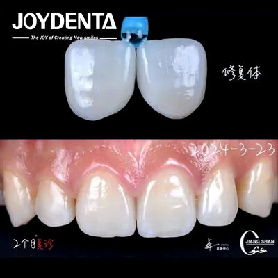 Mua Chỉ thị răng phía trước Lớp veneer răng không cần chuẩn bị và không đổi màu sản xuất trực tuyến