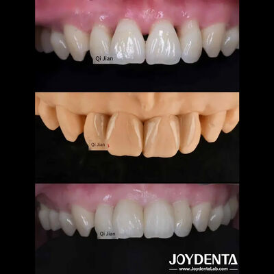 Mua Ghi đốm là giải pháp hoàn hảo cho các loại ghi đốm răng xuyên suốt tự nhiên sản xuất trực tuyến