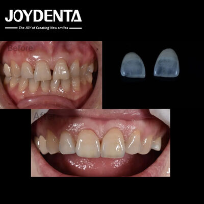 Mua 0.5mm Độ dày Ceramic veneers răng tự nhiên tìm kiếm cho răng phía trước chỉ báo sản xuất trực tuyến