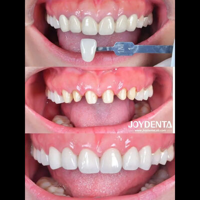 Mua Nghiên cứu điển hình về mão răng Zirconia | Gia công phòng lab toàn cầu - Joydentalab sản xuất trực tuyến