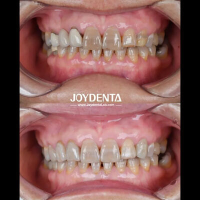 Mua Zirconia nha khoa nhẹ cho trải nghiệm bệnh nhân tối ưu Màu sắc tự nhiên sản xuất trực tuyến