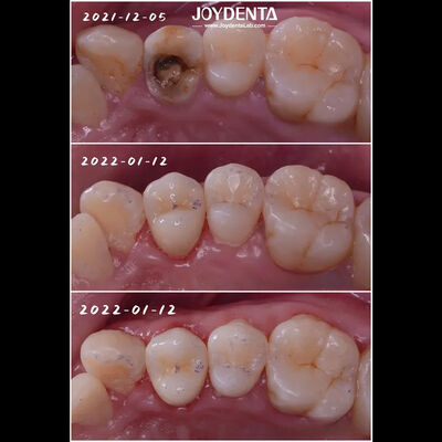 Mua Đúng phù hợp răng sứ đính kèm răng hư hỏng phục hồi cho người lớn và trẻ em sản xuất trực tuyến