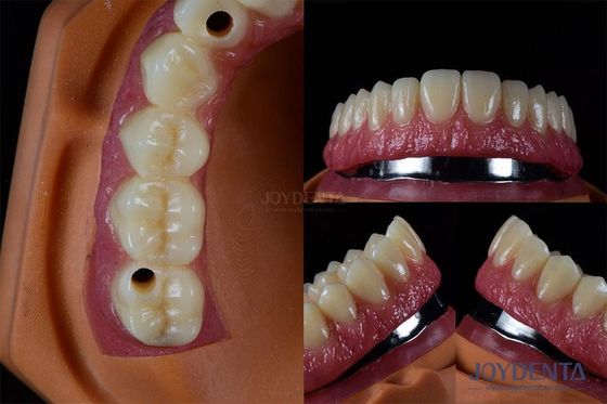 Titanium đa cấy ghép răng răng cấy ghép bên trong chống nứt tùy chỉnh