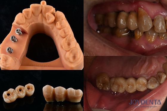 Ultra Hard Colour Stability Implant răng Vương miện OEM Dễ bảo trì lâu bền