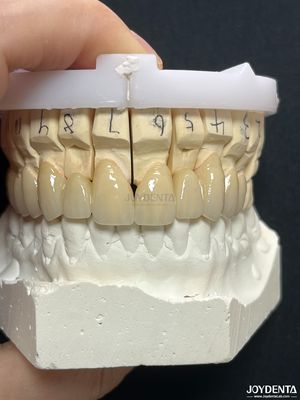 Vương miện kim loại kim cọ PFM liền mạch để phục hồi tương thích sinh học lâu dài