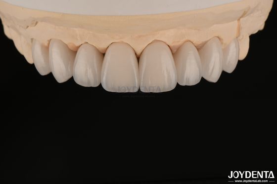 Các veneer răng mịn và nhẹ, tương thích sinh học và thoải mái cho sức khỏe răng miệng