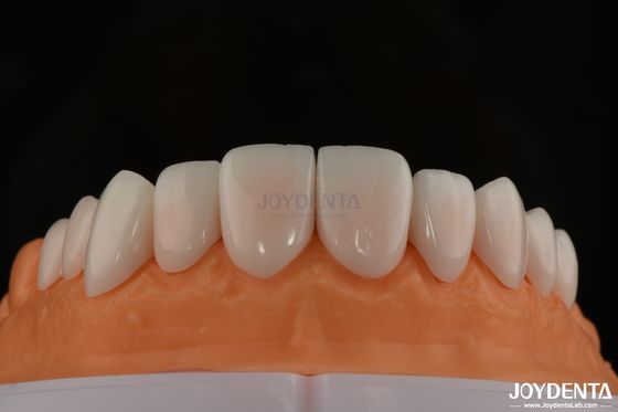 Sự thoải mái tối ưu cho bệnh nhân với veneers sứ tương thích sinh học và nhẹ nhàng trên các mô miệng