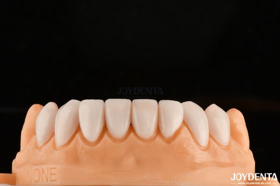 Liên kết mạnh mẽ với men răng để đảm bảo phù hợp veneers nha khoa tùy chỉnh cho sắc thái cá nhân để phù hợp với răng tự nhiên