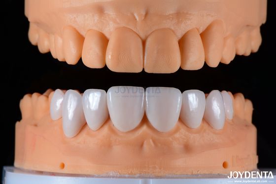 Bảo mật phù hợp Porcelain veneers gốm và thẩm mỹ tự nhiên với độ bám chắc
