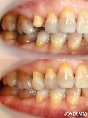 Tùy chỉnh giá cả phải chăng răng inlay phục hồi chính xác phù hợp với răng bị hư hỏng