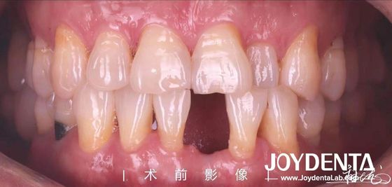 Đường nối nhựa Maryland có thể tùy chỉnh cho răng trước và răng trước