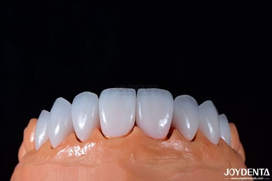 0.3-0.5mm Độ dày Emax Porcelain Veneer cho nha khoa thẩm mỹ bóng cao