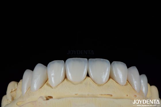 Mảng kết cấu bề mặt bóng Feldspathic Veneer Vỏ kết cấu sứ trông tự nhiên