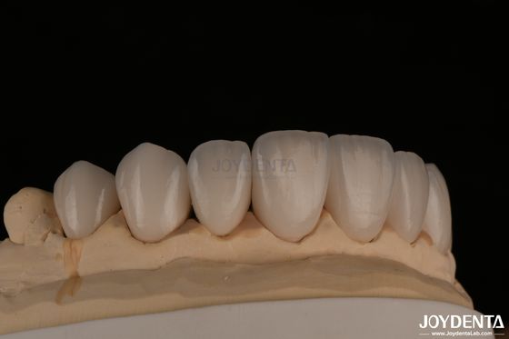 Feldspathic trông tự nhiên Veneers mỹ phẩm phù hợp chính xác Tương minh cao