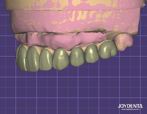 HIPAA phù hợp với bảo mật dữ liệu Digital Wax Up 3D Model cho sửa đổi răng