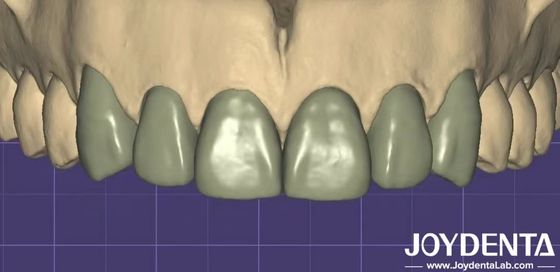 In 3D Virtual Digital Wax Up Khả năng tương thích liền mạch với phần mềm nha khoa khác