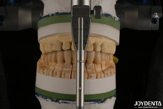 High Aesthetics Porcelain Layered Dental Zirconia cho phục hồi cấy ghép
