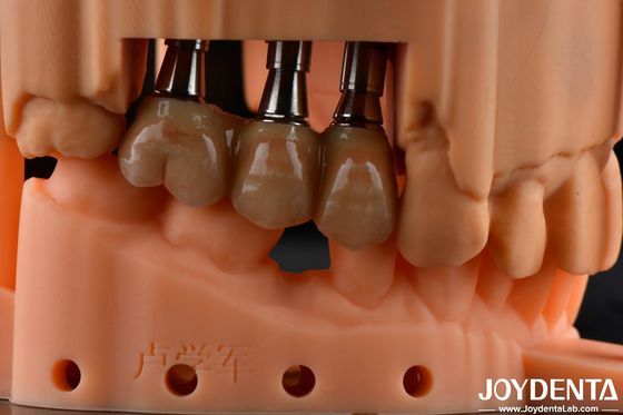Solution nha khoa Zirconia đầy đủ Full Arch Restoration