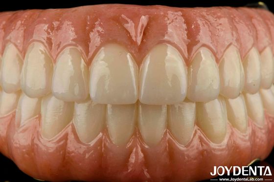 Đơn giản phù hợp răng Ti-Bar Zirconia Hybrid Bridge thay thế cho răng bị thiếu