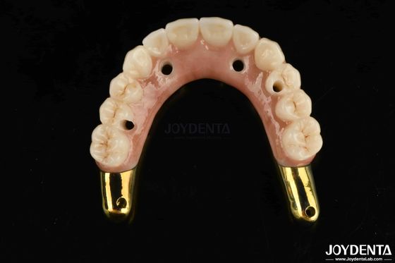 Chống mòn Zirconia Hybrid Bridge với Ti-Bar tương thích răng tự nhiên và nướu răng