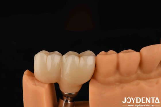Loại sợi hình V Abutments hoàn thiện tương thích với tất cả các hệ thống cấy ghép chính