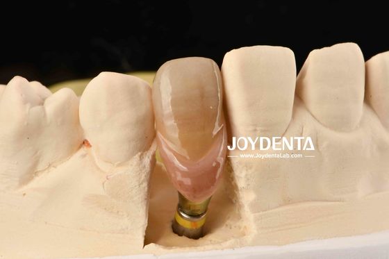 0° góc kết thúc Abutments răng 1.5mm Thread Pitch bề mặt đánh bóng
