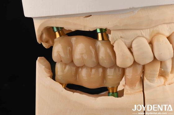4.5mm chiều cao đánh bóng nội bộ hex cấy ghép răng Abutments hình dạng V vít giữ
