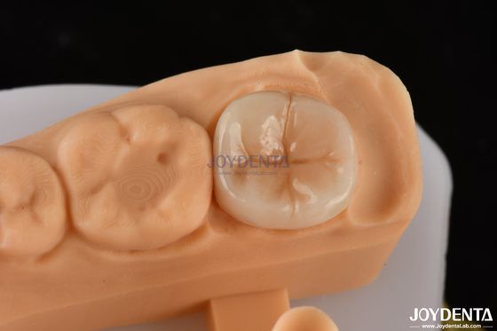 0.5mm-2mm Đúng phù hợp Emax răng Inlay Onlay cho sự phục hồi răng đáng tin cậy