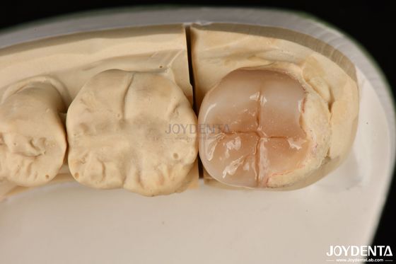 Dễ dàng Dọn dẹp Emax Inlays Và Onlays Hypoallergenic Biocompatible Restoration