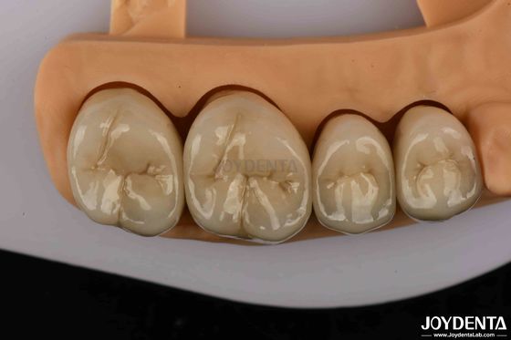 Vương miện răng bằng kim loại vàng và palladium cao cấp để tăng độ bền